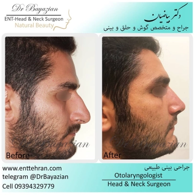 عکس عمل بینی طبیعی مردانه