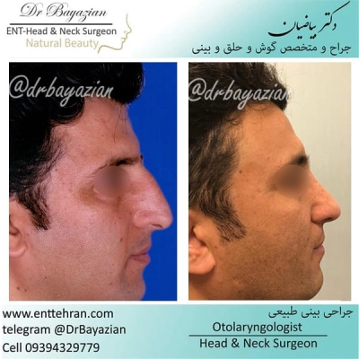 عکس عمل بینی طبیعی مردانه