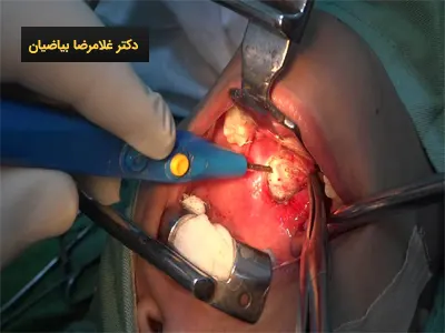 هزینه جراحی لوزه