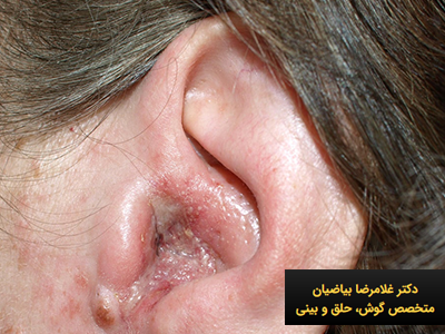 روش های درمان عفونت گوش میانی