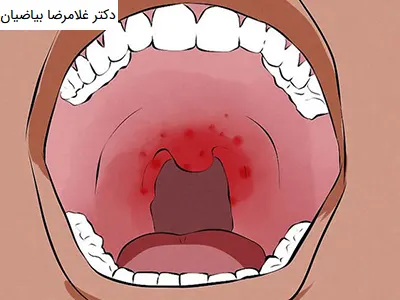 بهترین دکتر سرطان گلو