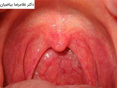 داروی سرطان گلو