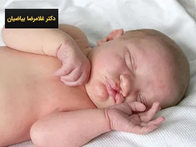 بهترین زمان جراحی شکاف کام و لب