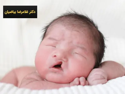 هزینه جراحی شکاف کام و لب