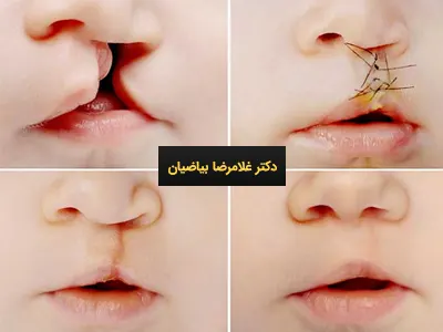 هزینه جراحی لب شکری