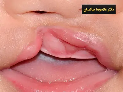 عوارض جراحی شکاف کام و لب