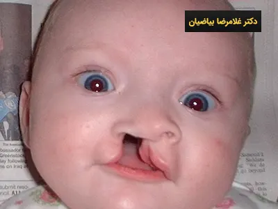 هزینه جراحی شکاف کام و لب