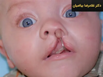 دلایل شکاف کام و لب