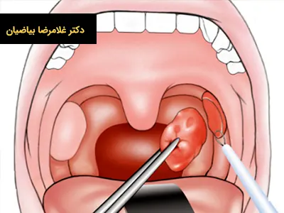 فواید جراحی لوزه سوم