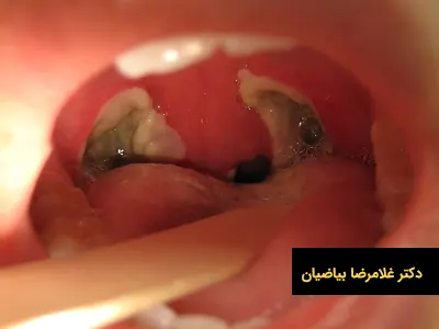 مزایای جراحی لوزه