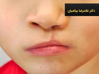 مشاوره ژنتیک شکاف کام و لب