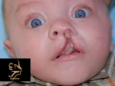 پاسخ به سوالات شکاف کام و لب