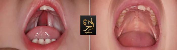 دلایل انجام جراحی شکاف کام و لب