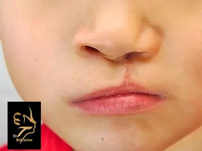 نکات بعد از جراحی شکاف کام و لب