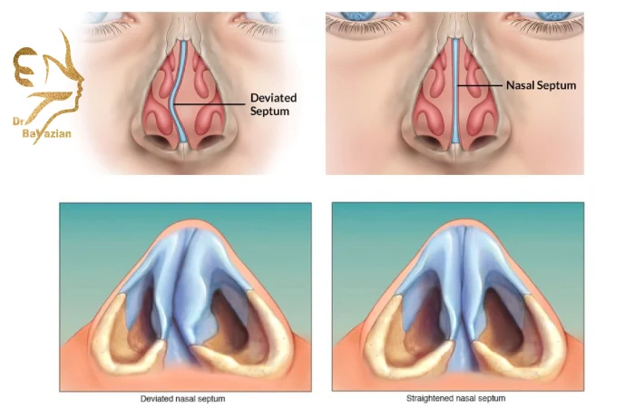 علت انحراف بینی