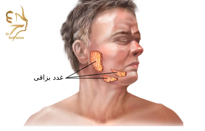 تومور غدد بزاقی چیست؟