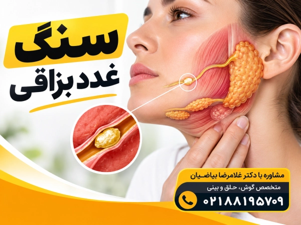 سنگ غدد بزاقی