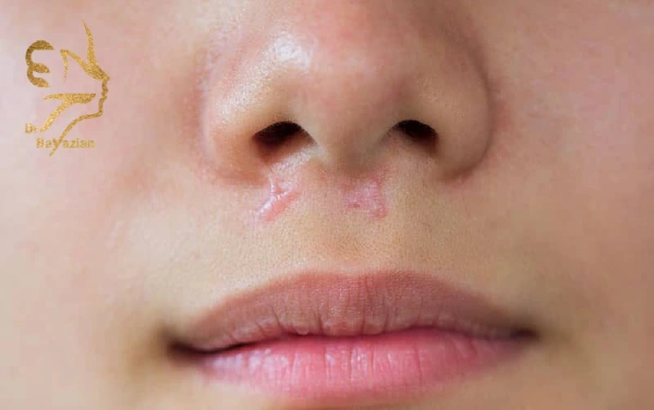 close-up-keloids-scars-on-face-skin گوشت اضافه بعد از جراحی بینی