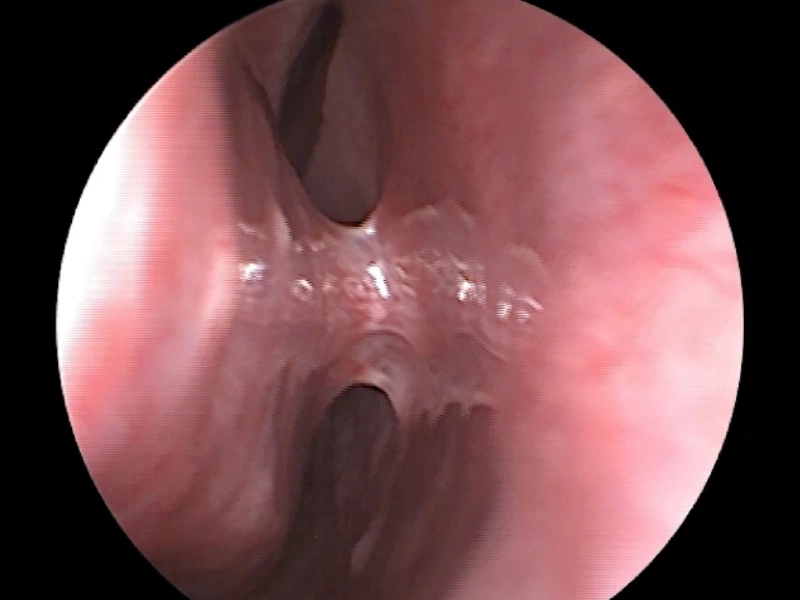 چسبندگی بینی