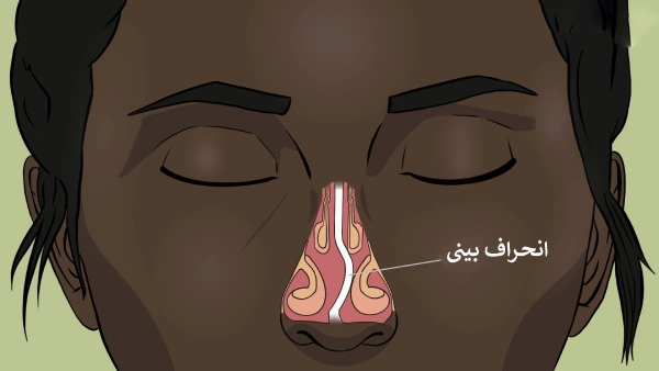 انحراف بینی