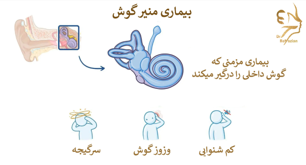 بیماری منیر گوش