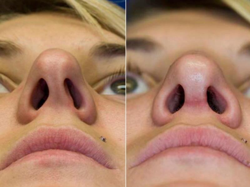 عمل انحراف بینی