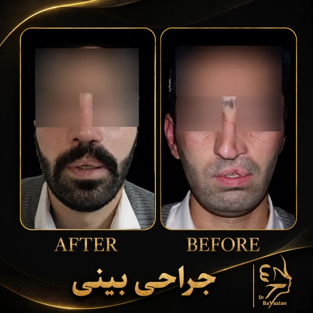 نمونه کار جراحی بینی