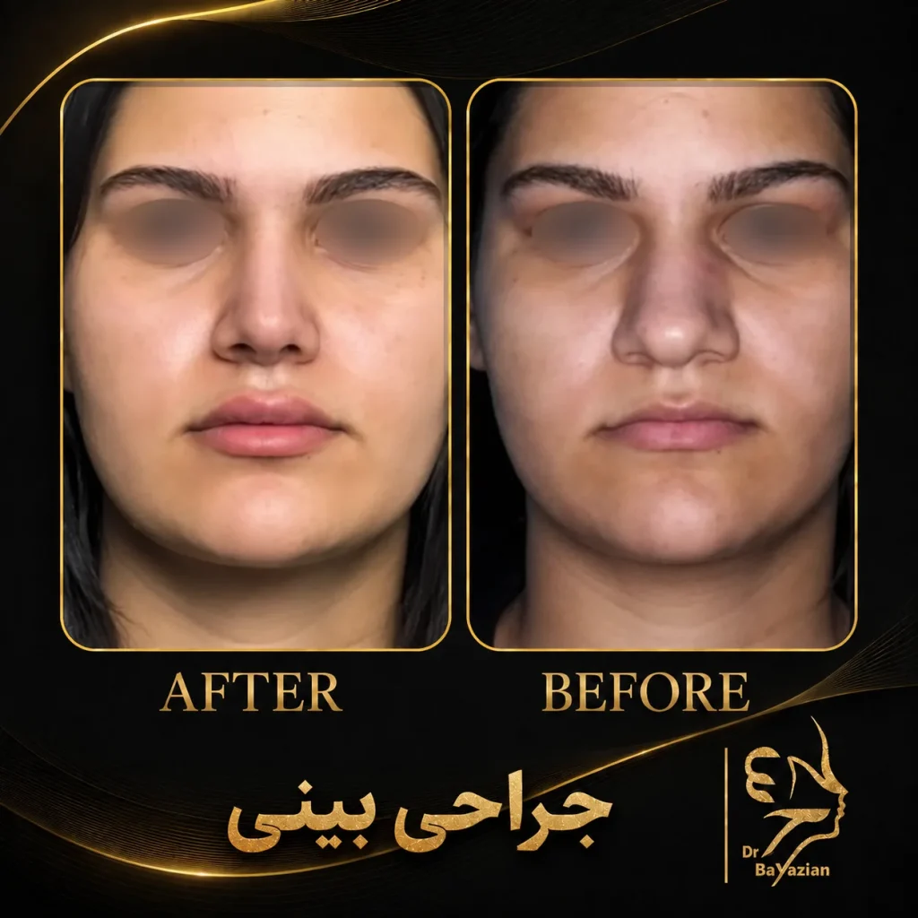 نمونه عکس جراحی بینی