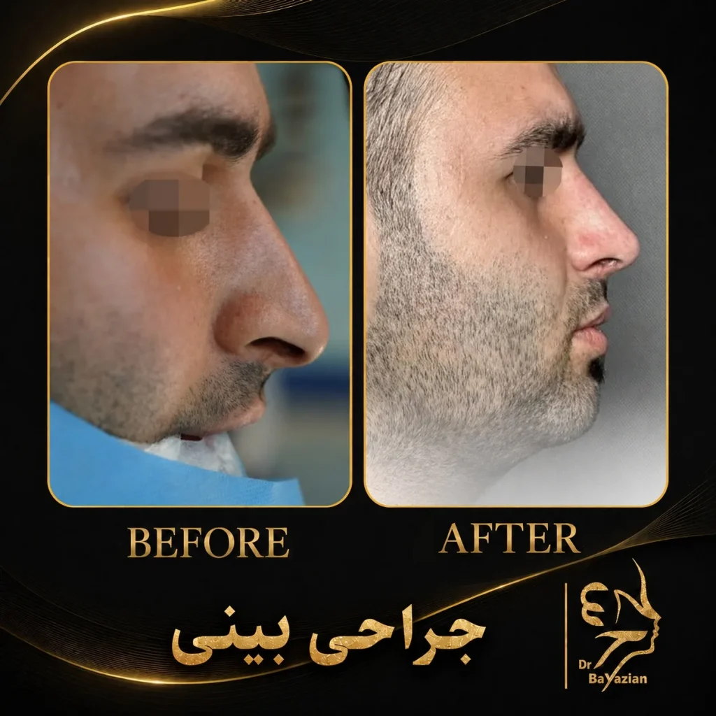 عکس جراحی بینی